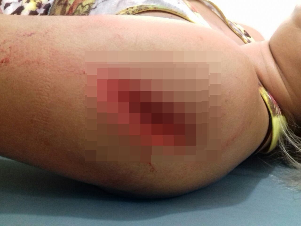 Mulher teve ferimento no braço e na mão