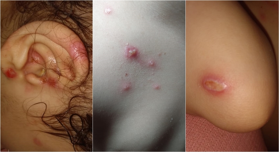 Chiara sofre com uma grava infecção no sangue