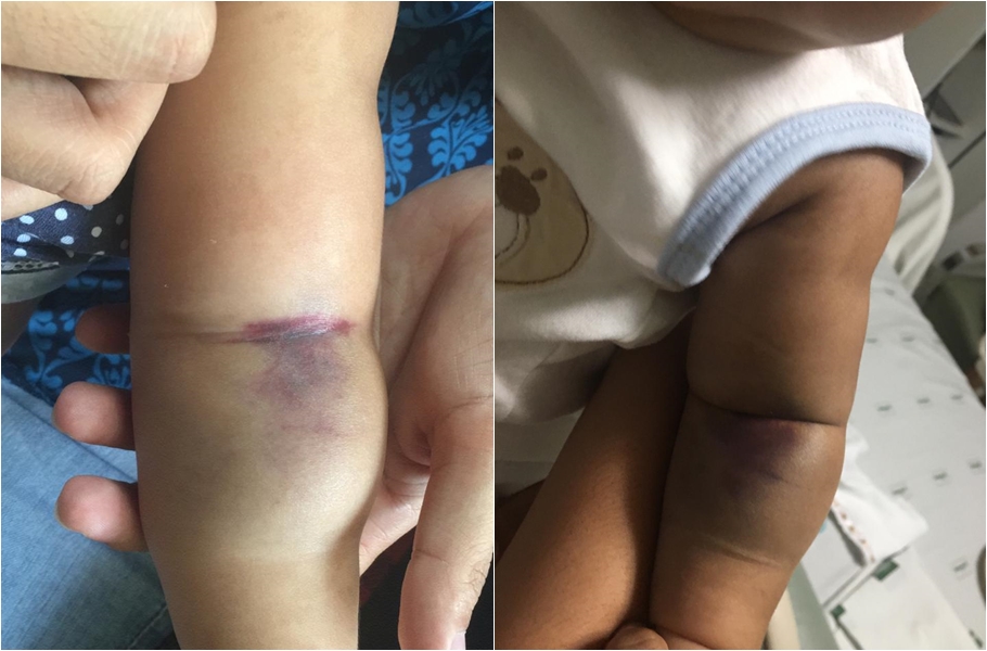 Hematomas aparentes no corpo do pequeno Miguel